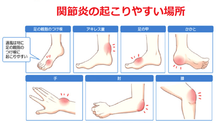 関節炎の起こりやすい場所・痛風は特に足の親指の付け根に起こりやすい