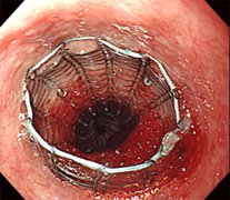 食道癌に対するステント留置の一例