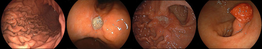 写真:上部消化管内視鏡検査
