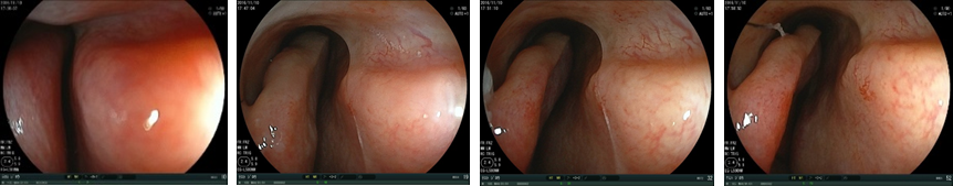 写真:拡張前から10分後までの鼻腔内