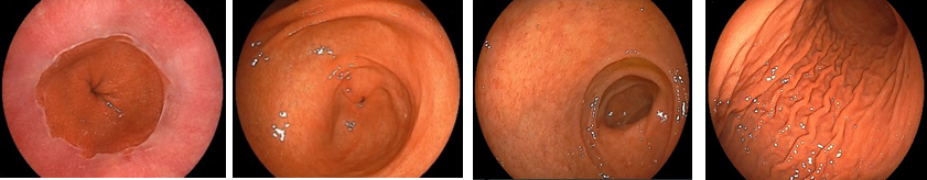 経鼻内視鏡の画像