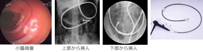 小腸画像　上部から挿入　下部から挿入