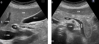 腹部超音波検査