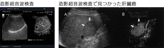 造影超音波検査　造影超音波検査で見つかった肝臓癌