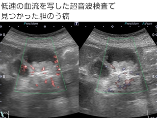 低速の血流を写した超音波検査で見つかった胆のう癌