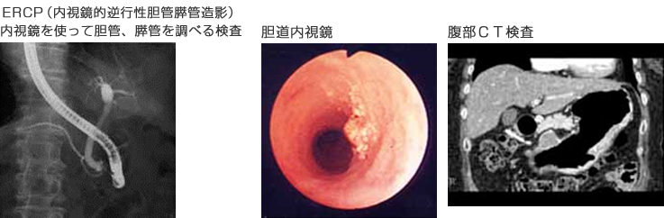 ＥＲＣＰ（内視鏡的逆行性胆管膵管造影）内視鏡を使って胆管、膵管を調べる検査　胆道内視鏡　腹部ＣＴ検査
