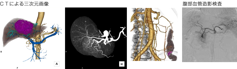 ＣＴによる三次元画像　腹部血管造影検査