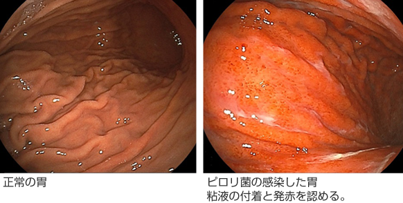 正常の胃とピロリ菌の感染した胃（粘液の付着と発赤を認める。）