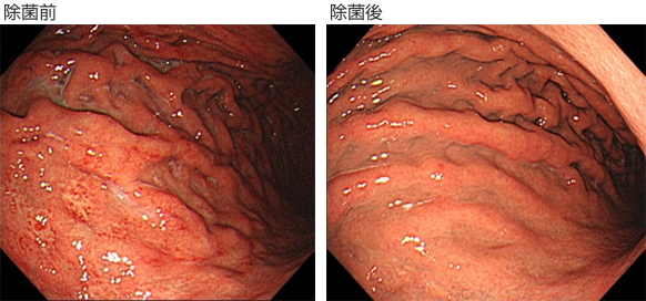 除菌前と除菌後