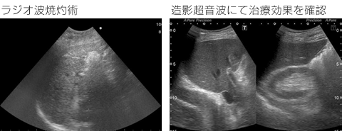 ラジオ波焼灼術　造影超音波にて治療効果を確認